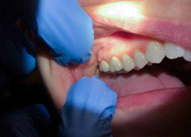 Best Emergency Dentist for Lost Fillings or Crowns in Bayshe, OR